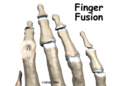 Finger Fusion Surgery - Summit Physical Therapy's Guide