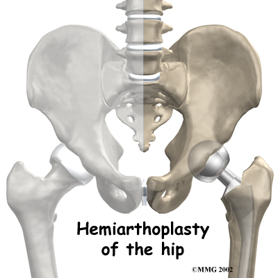 Hemiarthroplasty of the Hip