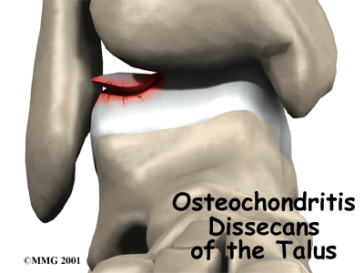 Osteochondritis Dissecans of the Talus